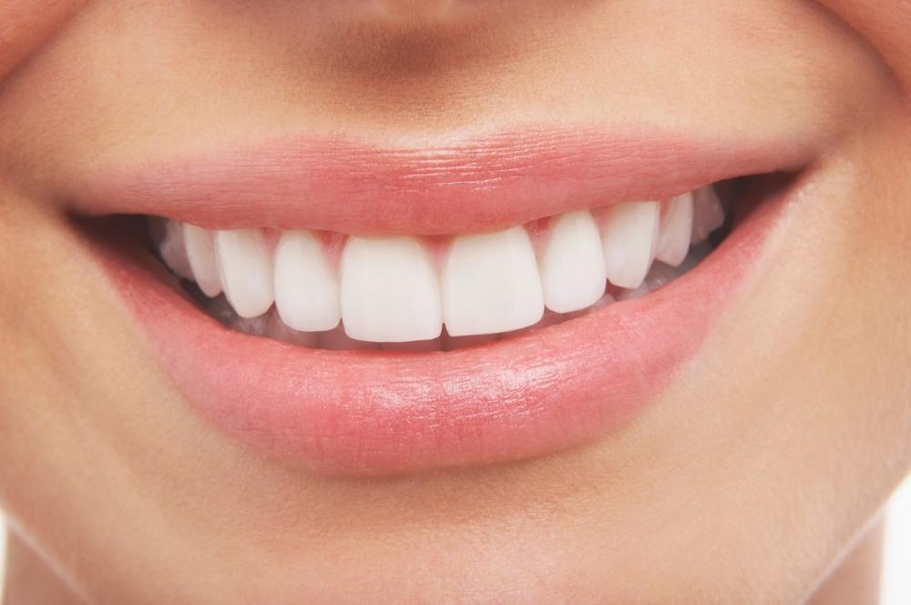 Gummy Smile